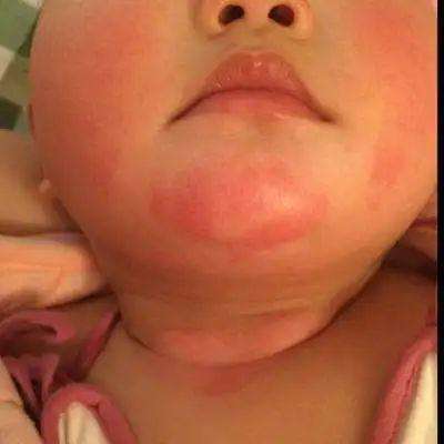 新生儿四种疹子,新生儿四种表现