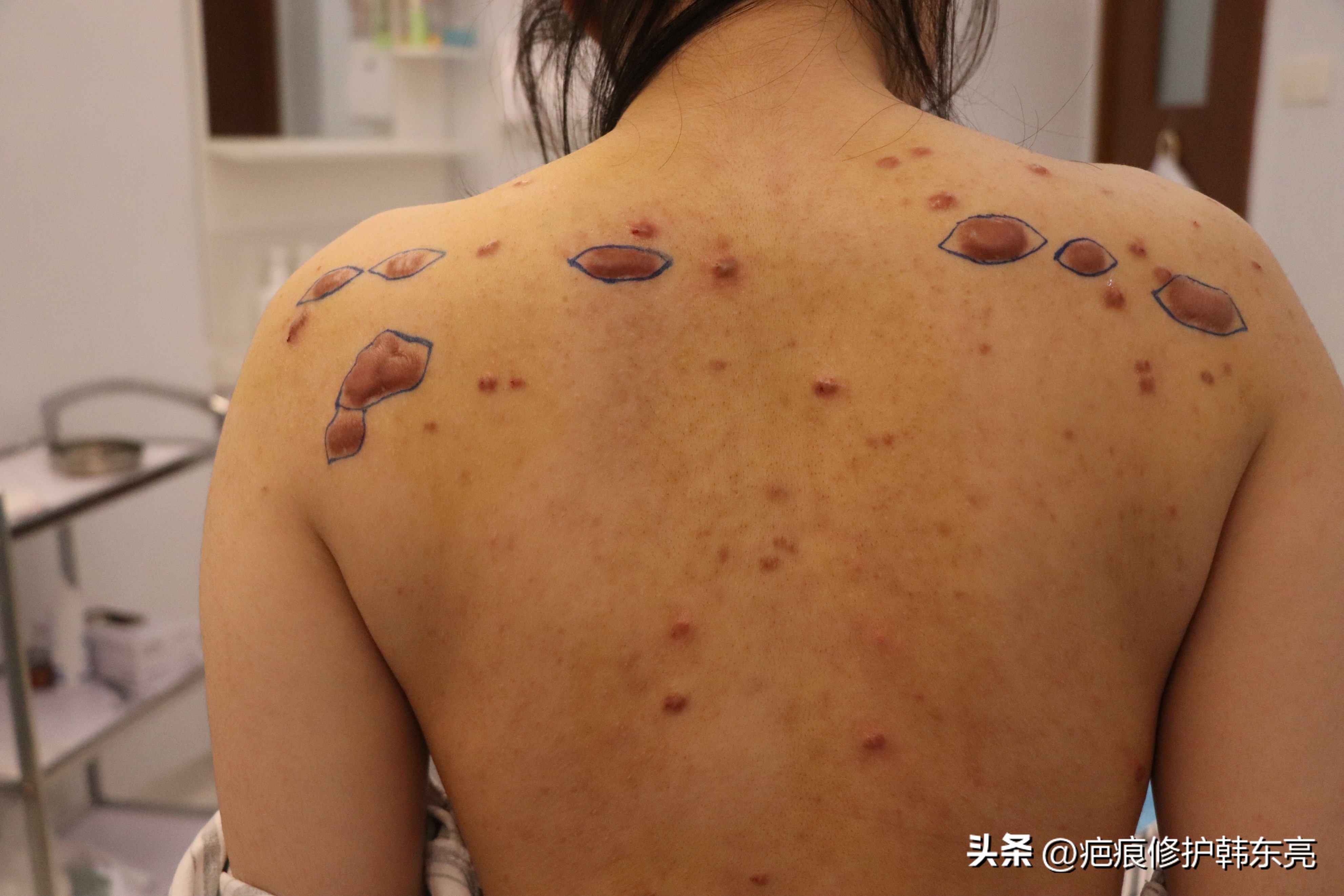 疤痕修复一次需要多少钱,上海九医院疤痕修复价目表2021