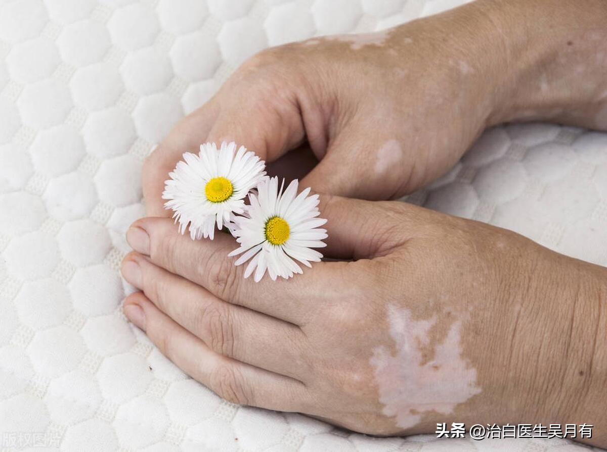 白癜风有没有省钱有效的方法,白癜风治疗省钱妙招