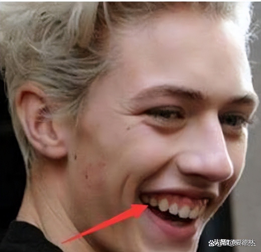 笑起来露牙龈的很难看怎么改善,笑起来不好看露牙龈怎么办