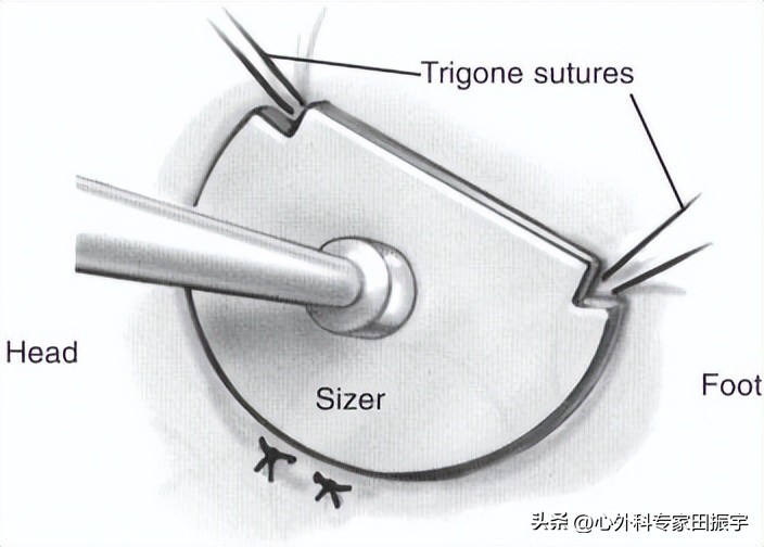 二尖瓣成形术要多少钱,二尖瓣成形术后抗凝多久
