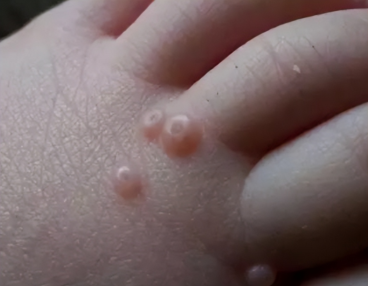 治疣药,治疣瘊的药