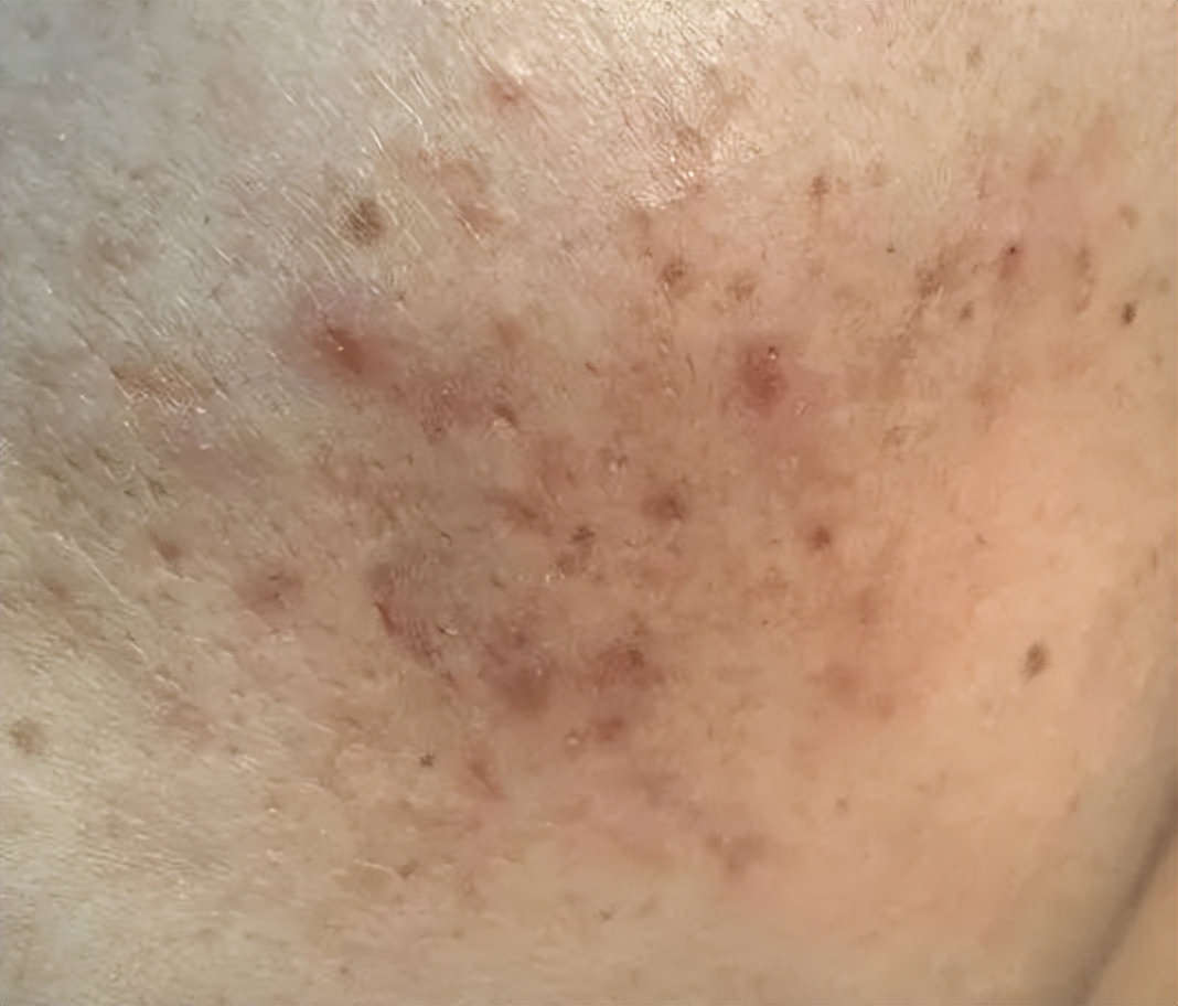 面部痘印中医治疗方案方子,脸上痘印中医的治疗方法