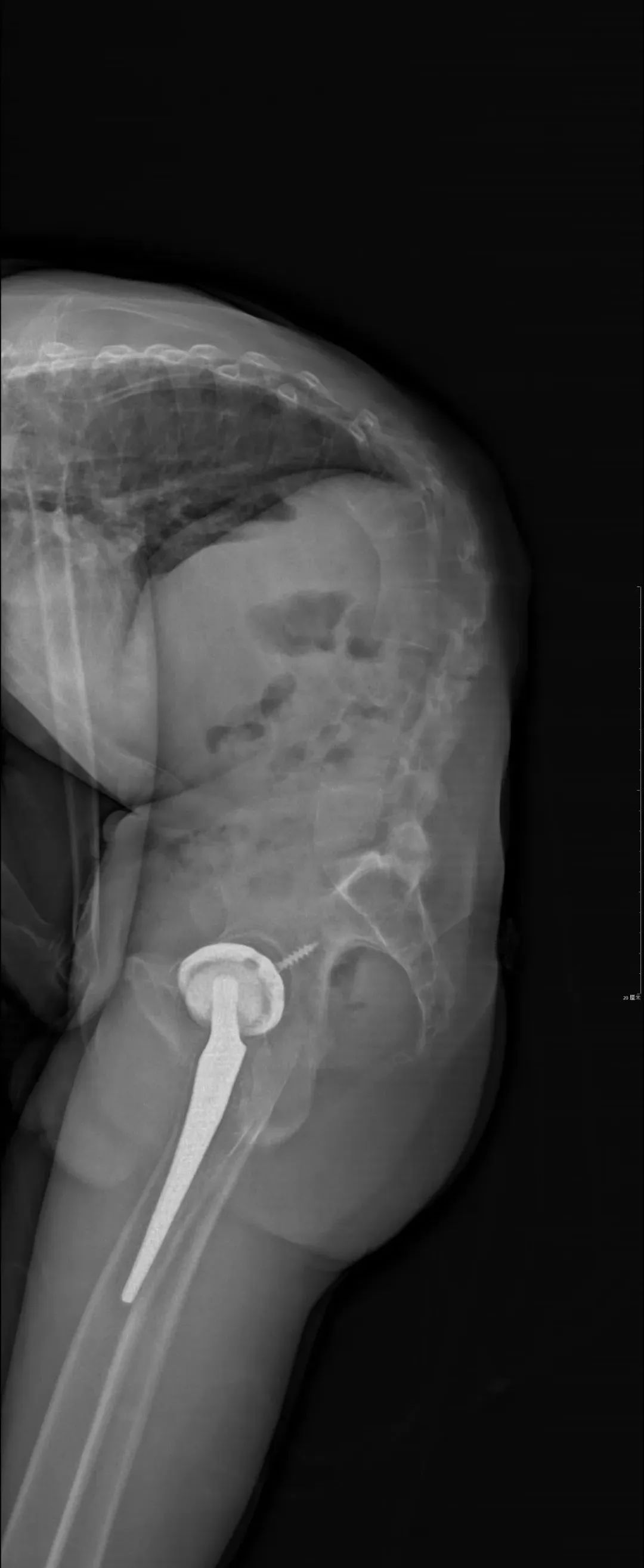 手术后平躺六小时睡着了,手术后终于睡着了