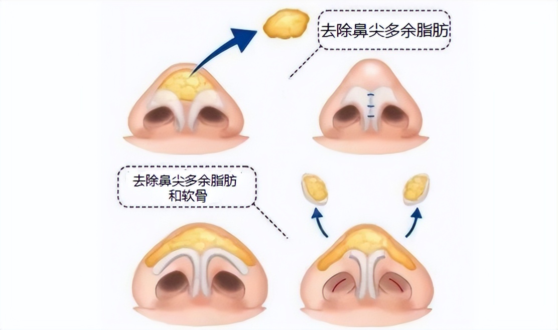 鼻子肉多鼻翼宽怎么办,鼻头鼻翼缩小手术分享