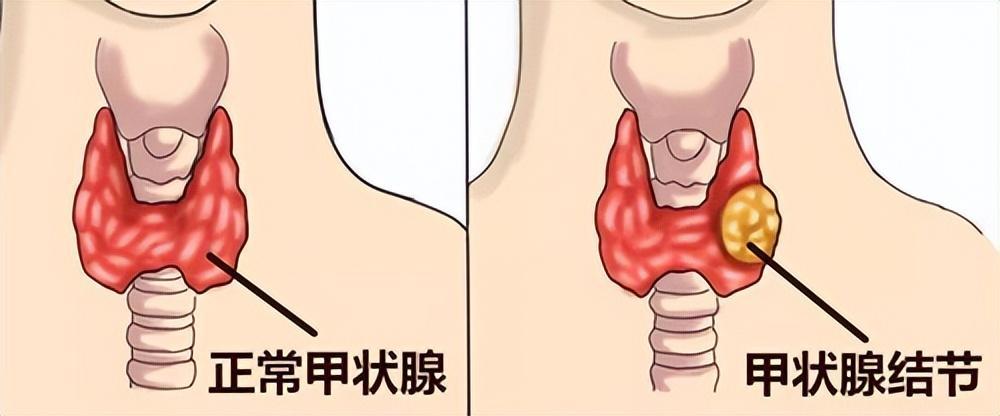 体检查出这十种病不用治疗,真正的医院不建议体检的三种病