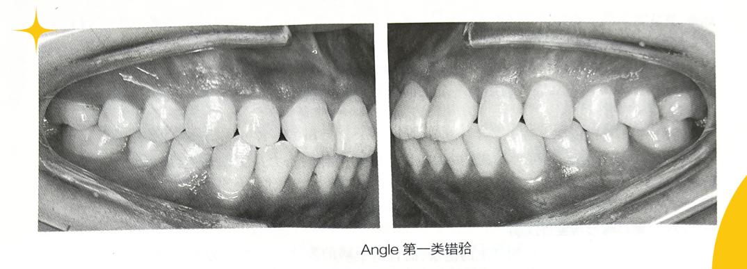 病例分析诊断错了后面还能分吗,错颌畸形的分类
