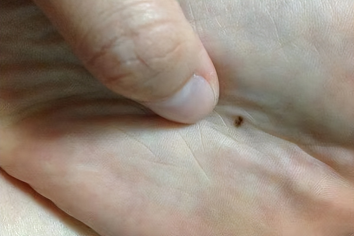 右脸上的痣要不要点掉,脸上的痣不能乱点的说法