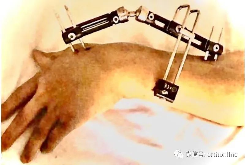 桡骨远端骨折复位固定手法,桡骨骨折闭合复位内固定术