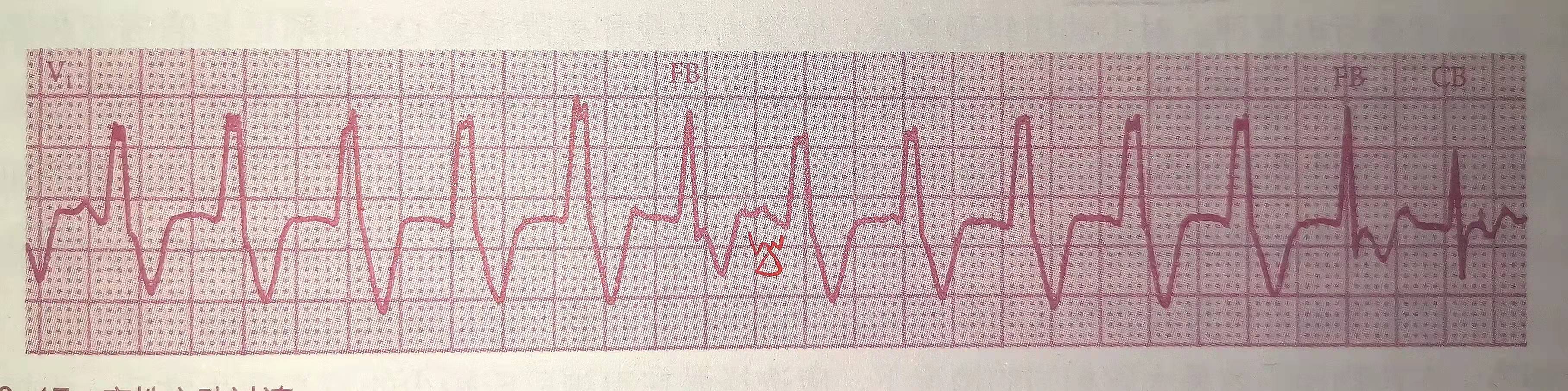 心律失常四型,心律失常四肢乏力胸口难受