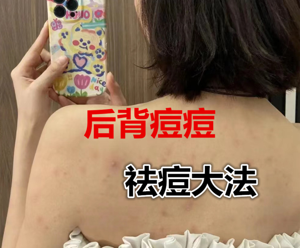 一分钟消除脓包痘,清除脓包型痘痘实操