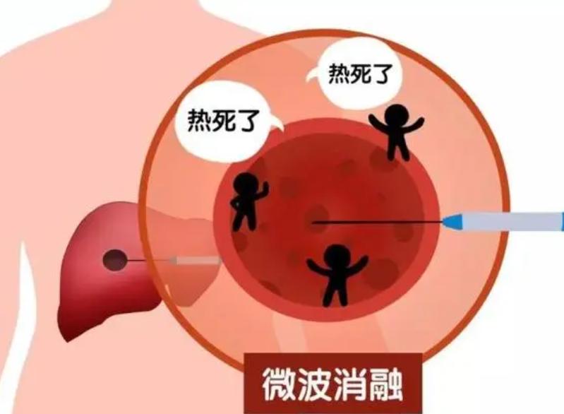 精准微创介入治疗肿瘤效果怎么样,哪些属于微创介入治疗