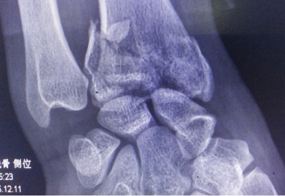 吃虾皮能起到补钙的效果吗,吃虾皮真的能补钙吗能补多少