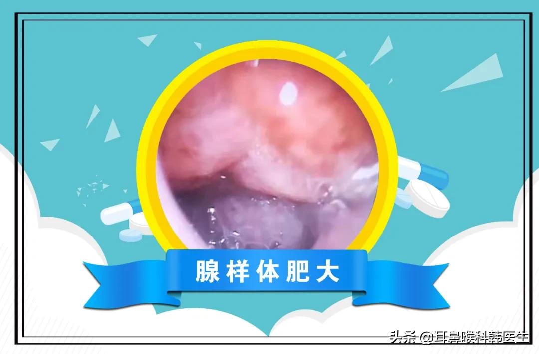 耳鼻咽喉镜检查痛不痛,耳鼻咽喉内窥镜检查是检查什么