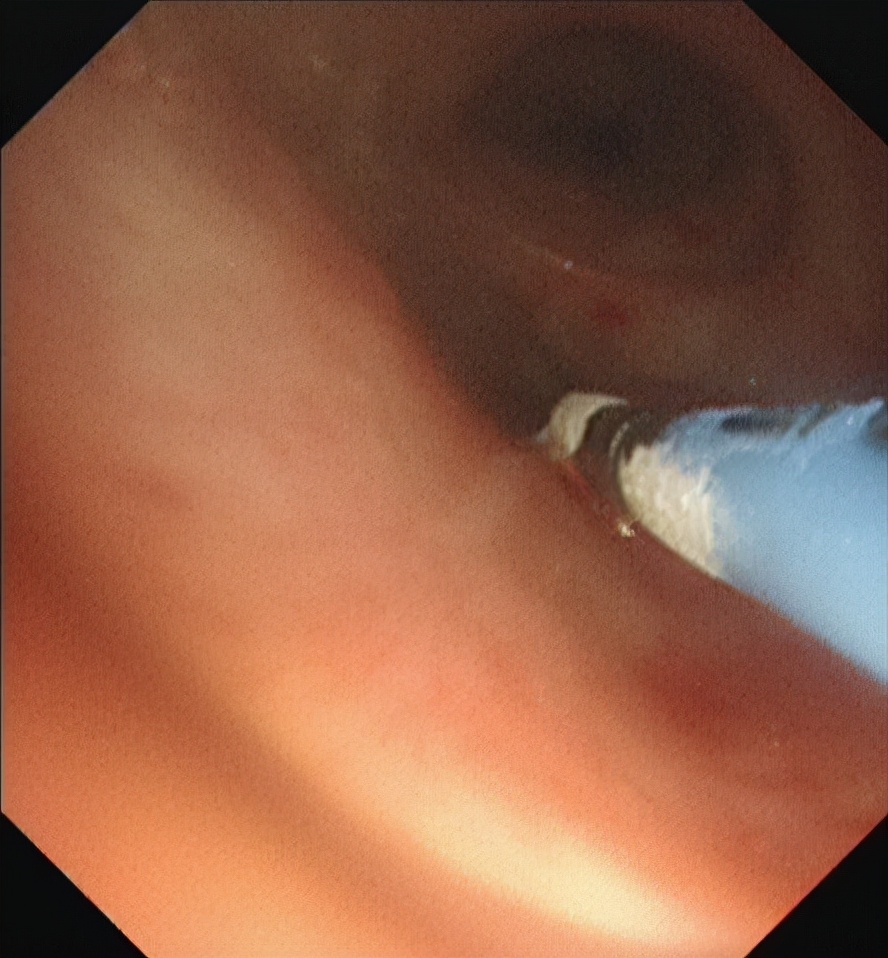 气管镜下肿瘤怎么治疗,气管肿物是什么