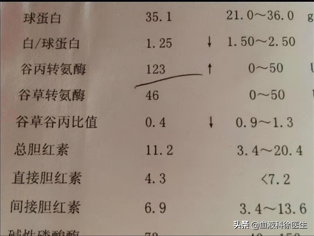谷丙转氨酶91谷草转氨酶57严重吗,谷丙转氨酶与谷草转氨酶高怎么办