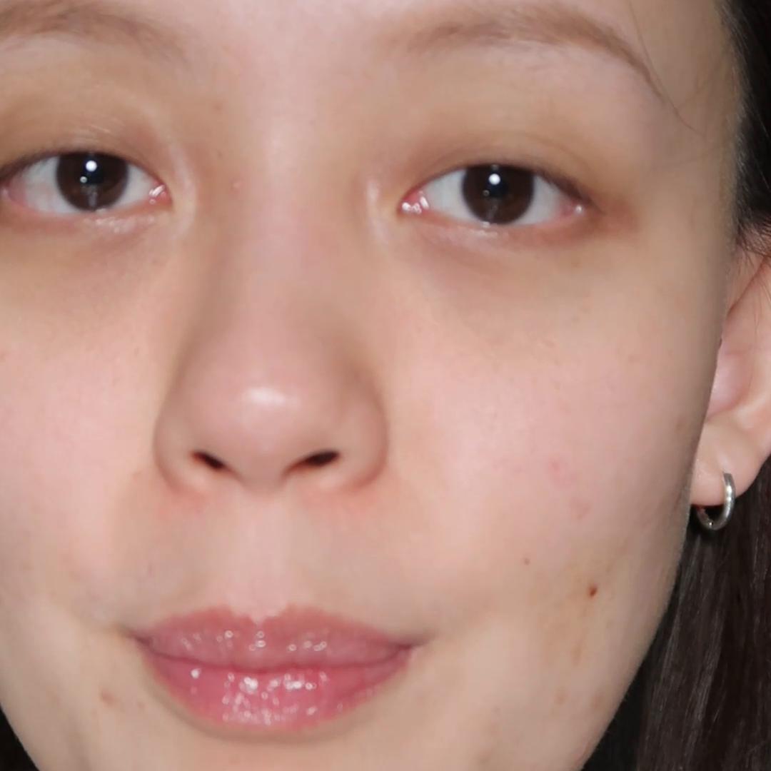 痘肌祛闭口的最好方法,闭口混合痘肌如何护肤