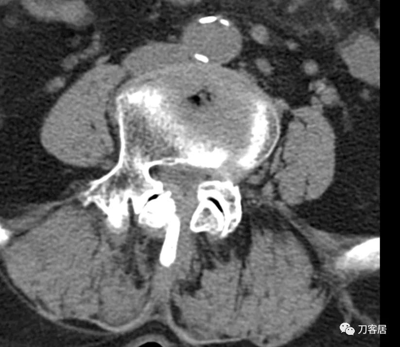 老年人腰骨裂不手术怎么治疗最好,老年腰椎骨质疏松症