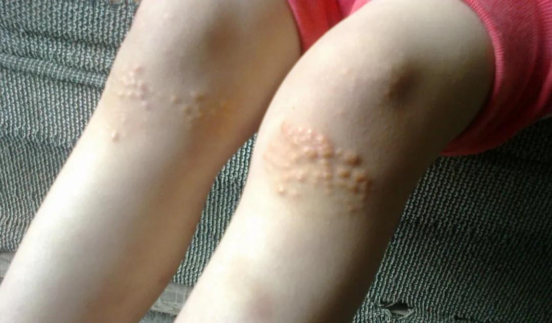 皮肤科董医生,皮肤科董医生的网络门诊分享