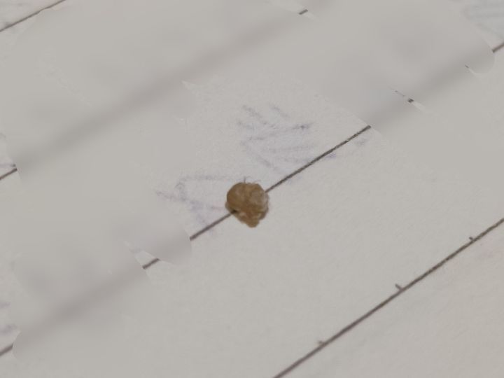 为什么鼻子可以挤出很大的黑头,用夹子挤出鼻子黑头