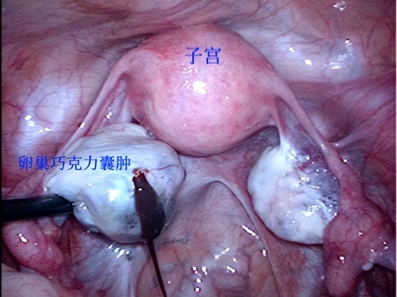 卵巢囊肿超声穿刺手术怎么做的,黄体囊肿与卵巢囊肿的超声区别