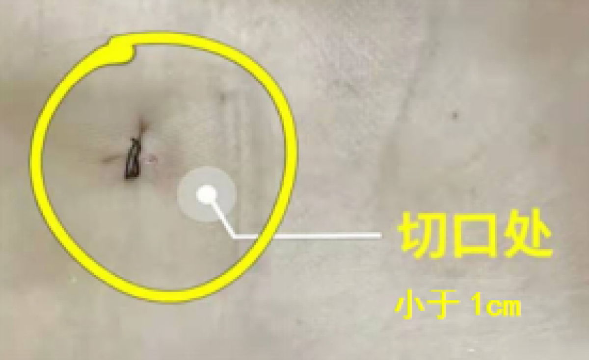 漯河骨科腰间盘突出微创,微创小切口腰间盘突出