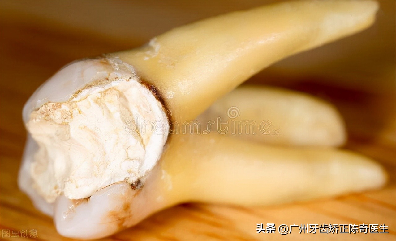 蛀牙是怎么形成的？是细菌么，是的话是怎么把牙齿吃成一个洞？