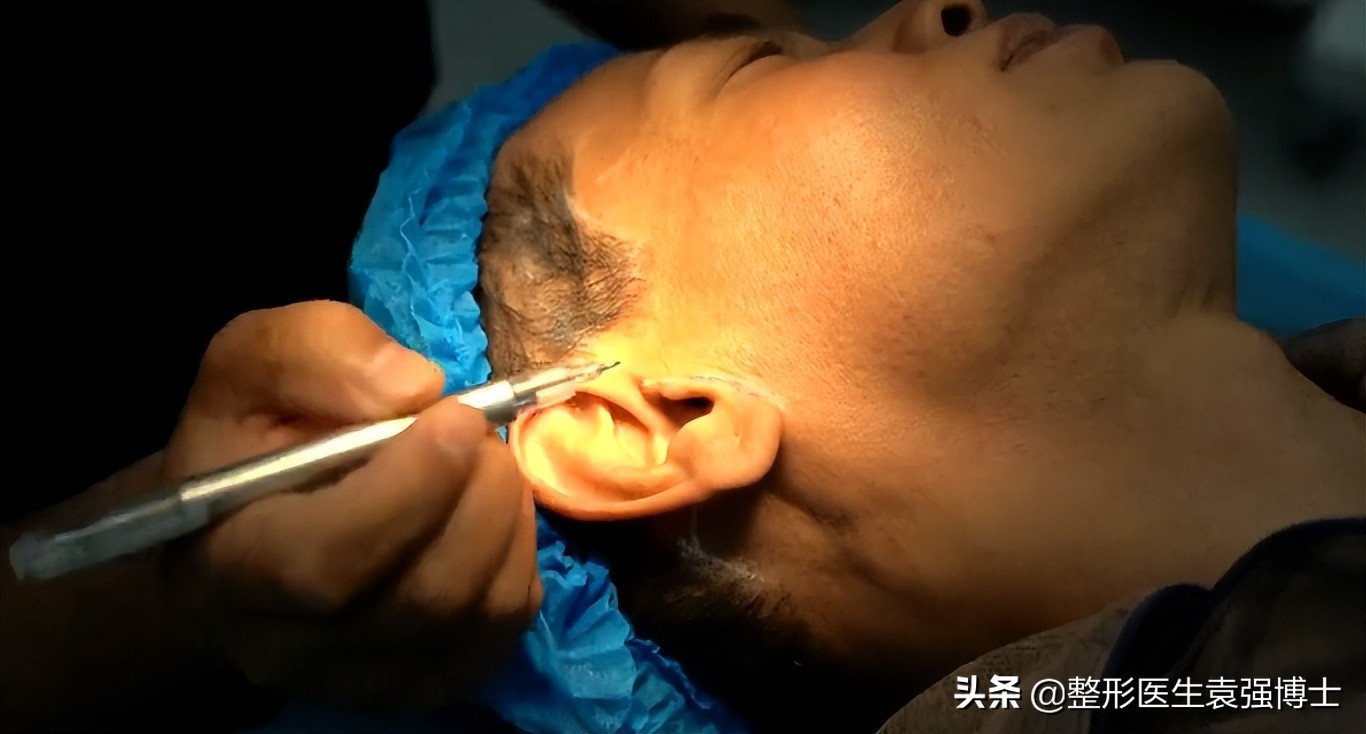 拉皮手术那么危险为什么还有人做,拉皮手术的真实感言