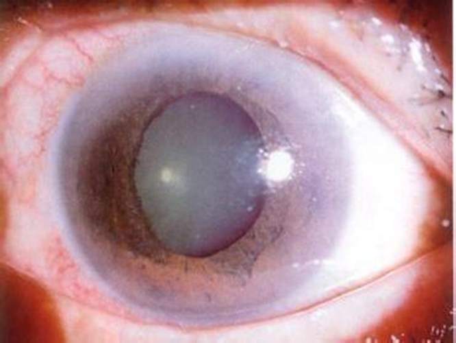 治疗青光眼的复合眼药水,乙酰唑胺治疗青光眼怎么吃