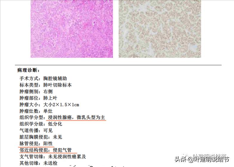肺腺癌高危亚型什么意思,肺腺癌高危亚型