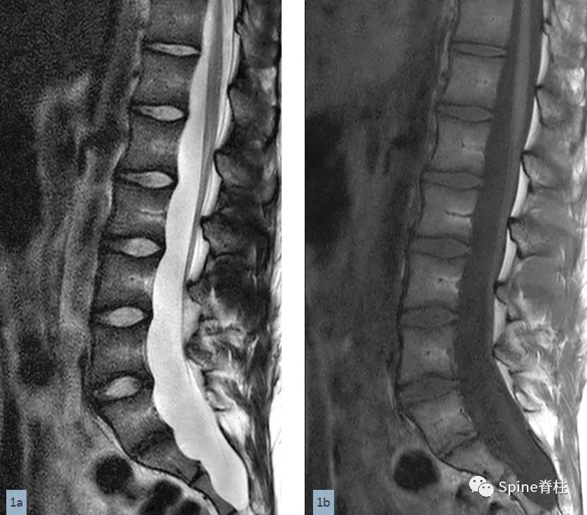 硬膜扩张,duralectasia