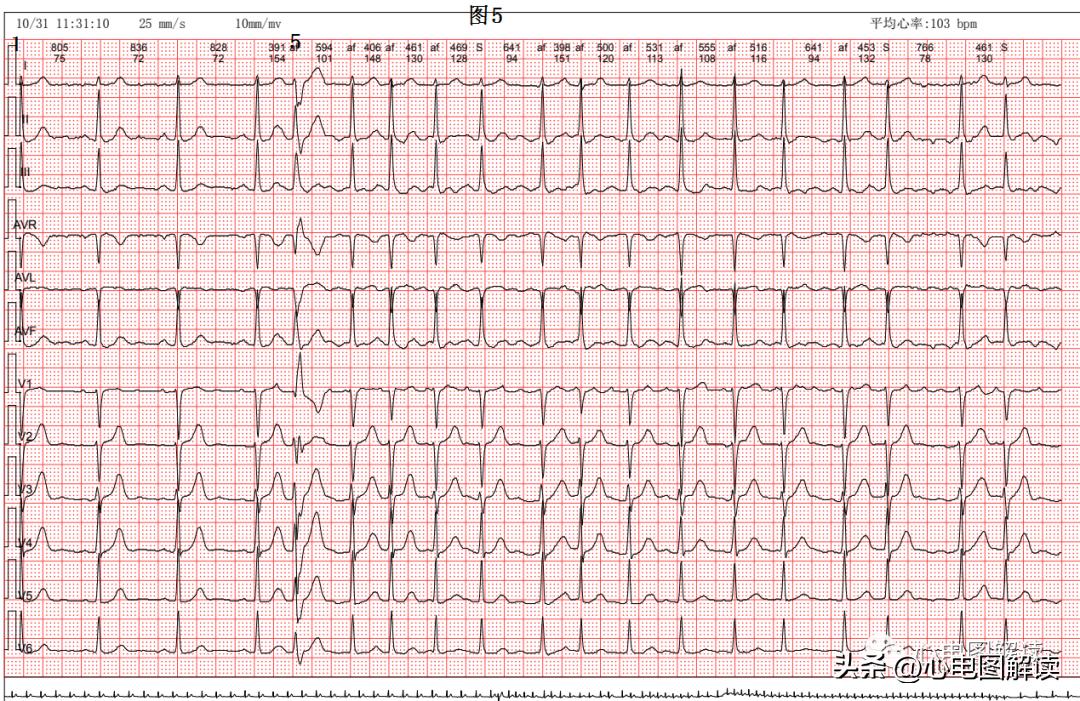 房性早搏和房颤会同时存在吗,频发房早会演变成房颤吗