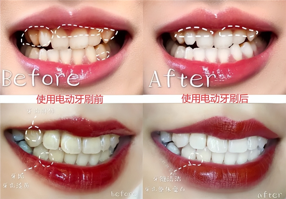 长时间用电动牙刷有害处吗,每天用电动牙刷刷牙害处