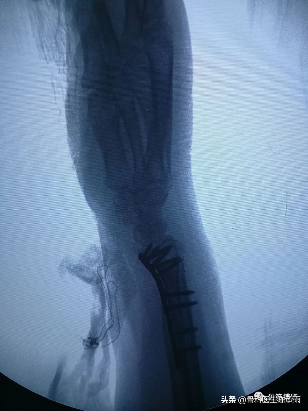 桡骨远端骨折累及关节面保守治疗,桡骨骨折保守还是手术