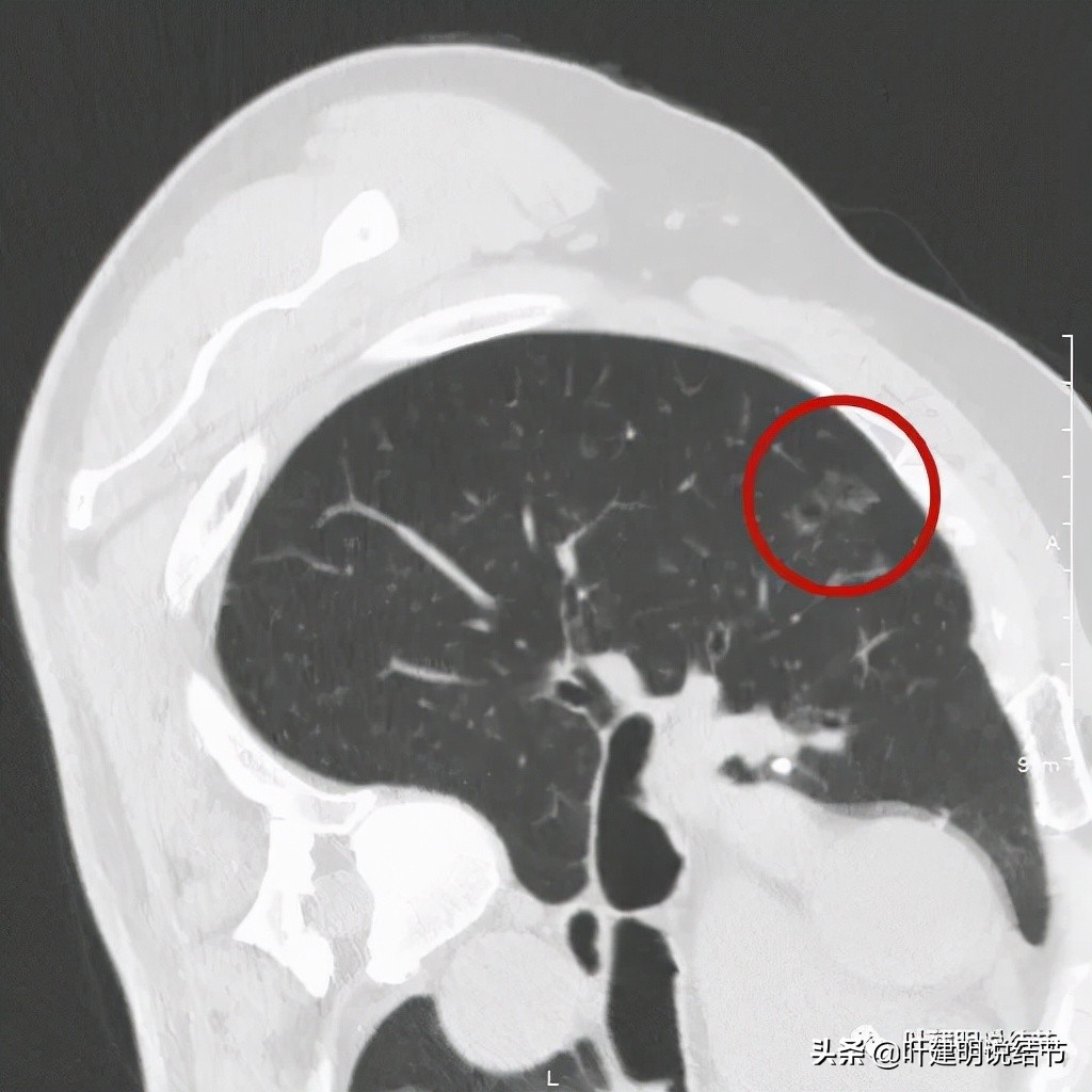 肺多发结节切除一个剩下的怎么办,无限纠结的肺小结节
