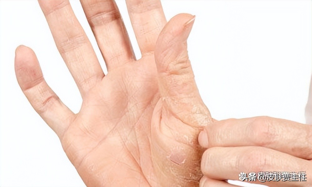 读完这篇文章，让你知道银屑病到底是什么，如何科学地来治疗