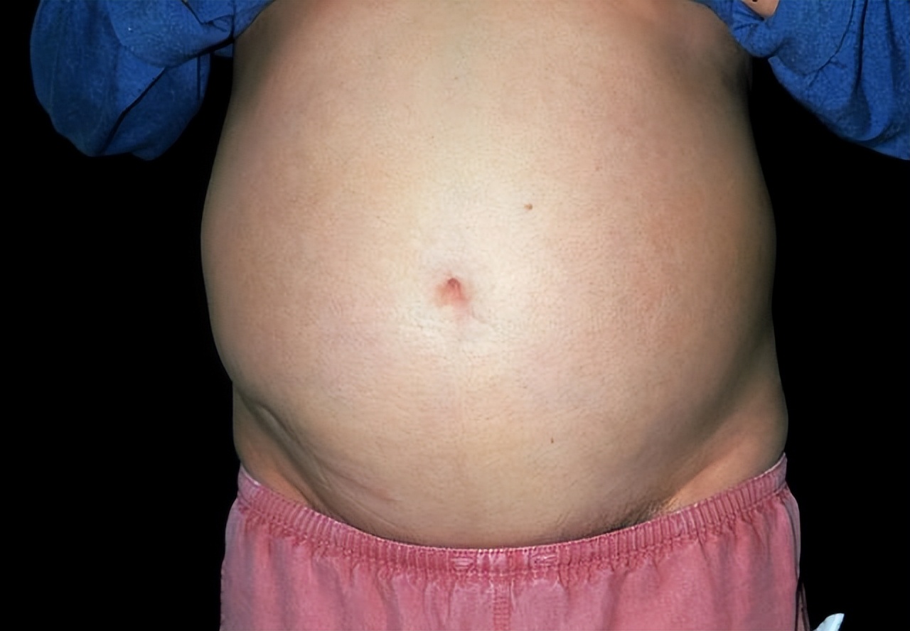 肝癌腹水晚期死亡前三个月征兆,肝癌腹水最快的解决方法