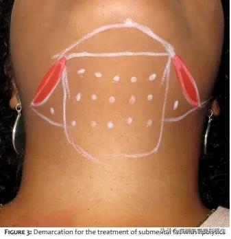 抽脂针瘦脸,抽脂溶脂针