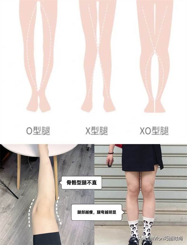 腿不直真的显腿粗吗,腿粗不是因为不够瘦是腿型不直