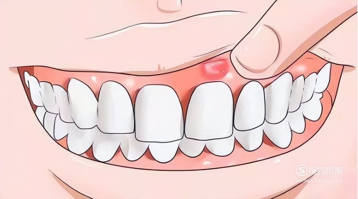 口腔癌早期的5个危险信号,口腔癌早期5大症状及表现