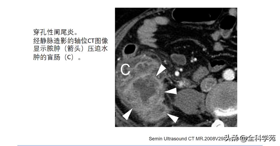 阑尾炎的讲解,关于阑尾炎的讨论总结