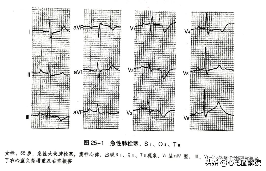 II、III、aVF导联的正常q波、异常Q波