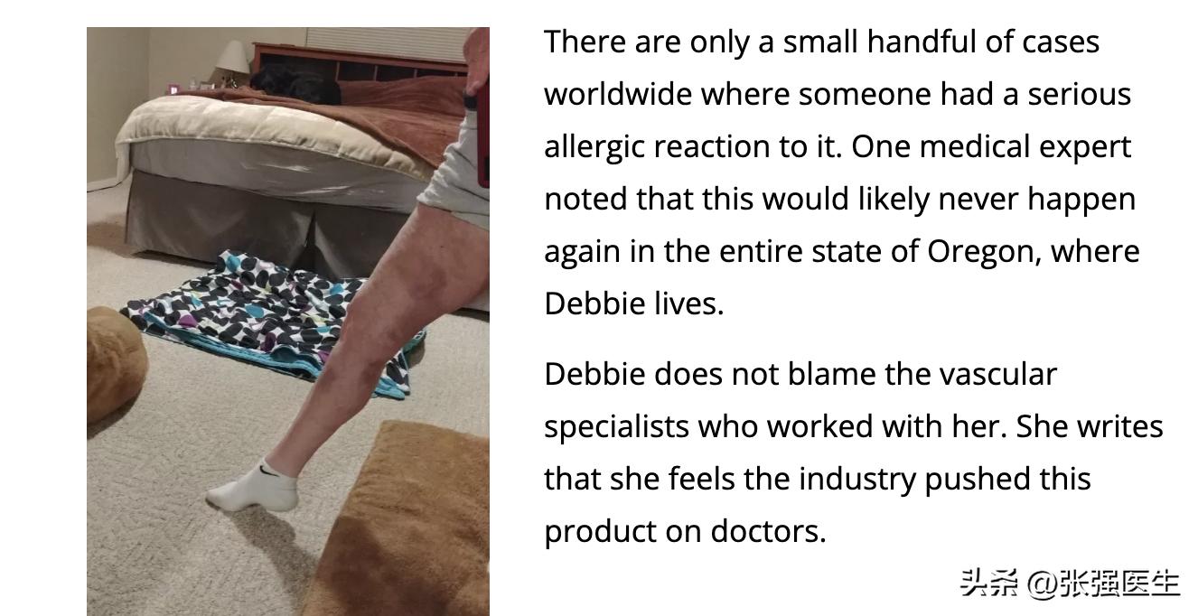 生物电疗可以治疗下肢静脉曲张,射频技术治疗下肢静脉曲张缺点