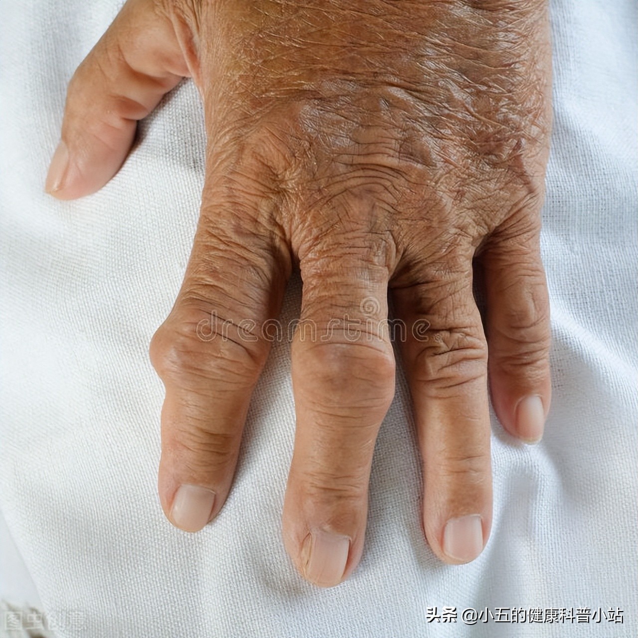 非布司他是防治痛风的常用药，可以长期服用，但需要注意这4点