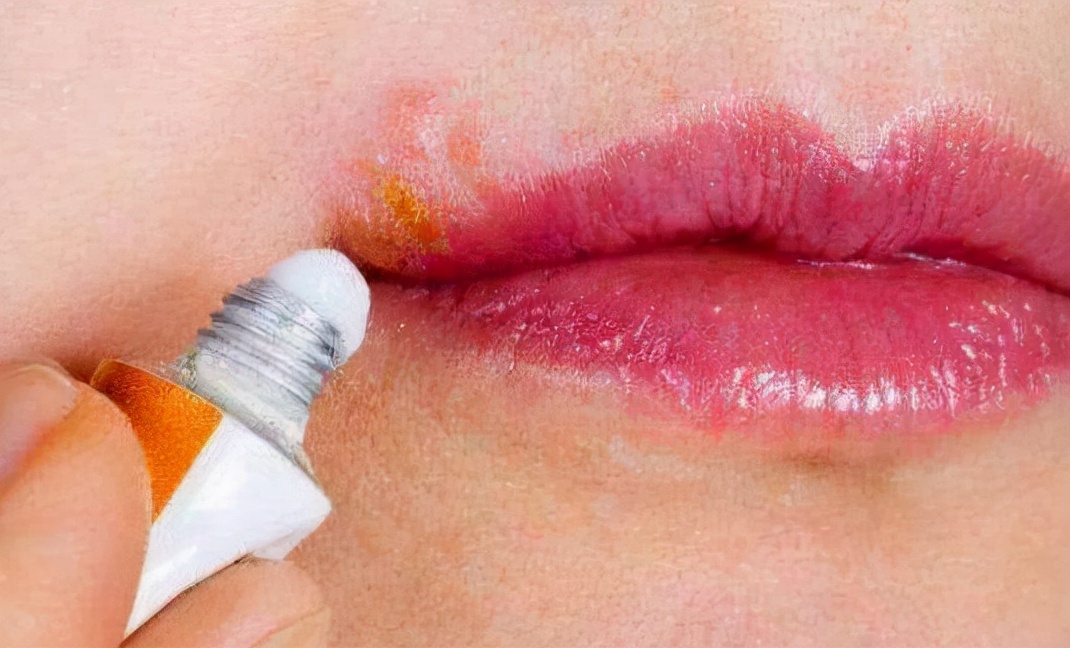 嘴巴旁边很多小水泡会留疤吗,嘴巴周围长一堆小水泡是上火吗