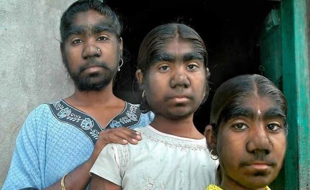 故事:非洲17岁女孩长满络腮胡,毛发从鼻孔长到脖子,身体有何异常