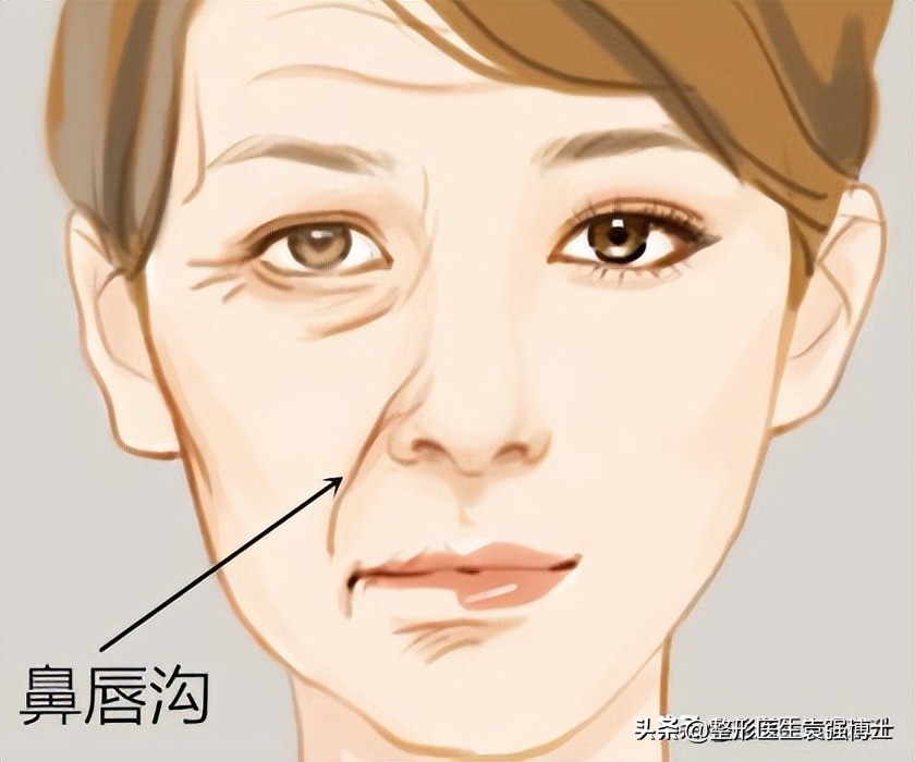 有什么办法能解决法令纹,有法令纹最好的解决办法真实有效