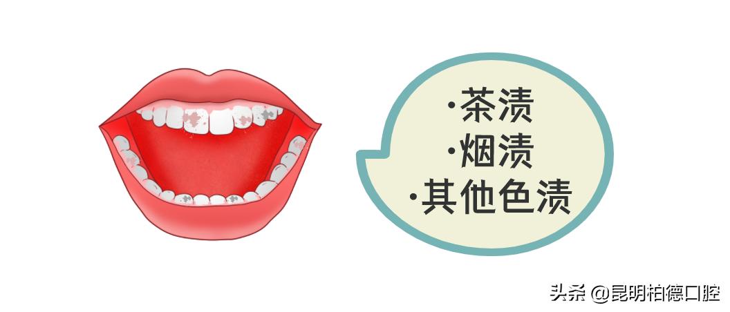 洗牙里面喷砂和抛光有什么区别,洗牙抛光和喷砂抛光的区别