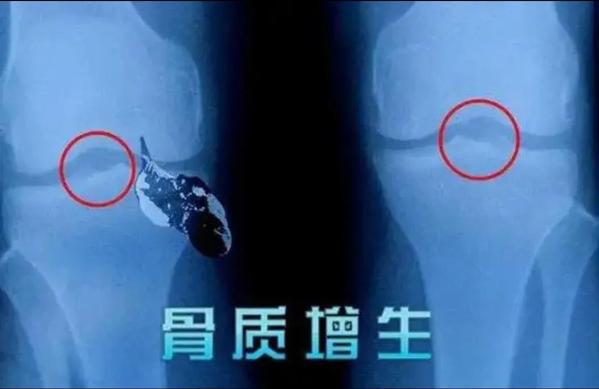 骨刺形成的原因和缓解疼痛的方法,骨刺和骨质增生能吃骨刺平吗