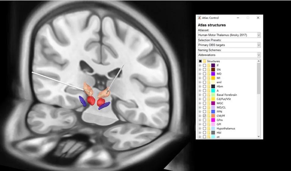 治疗癫痫的新希望,癫痫病人能做慢性小脑电刺激术吗